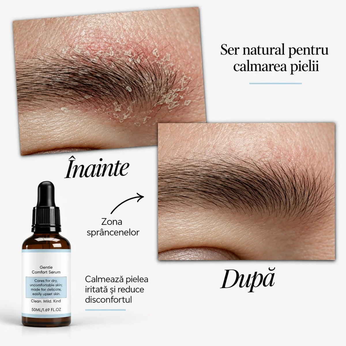 Ser natural pentru calmarea pielii iritate – Reduce roșeața, mâncărimile, descuamarea și senzația de disconfort a pielii.